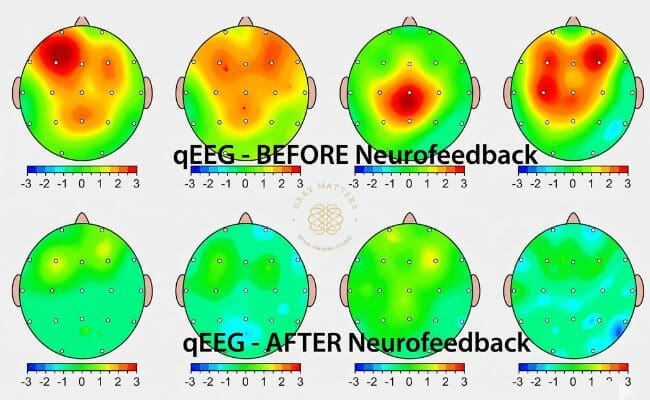 visual report of qeeg brain map before and after neurofeedback session